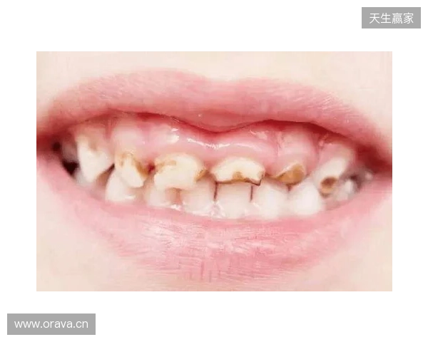 韦林顿确诊上唇部贯通伤;11、21牙半脱位;上颌前牙区牙槽骨骨折